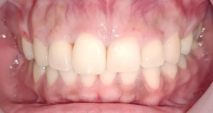 Antes del tratamiento periodontal