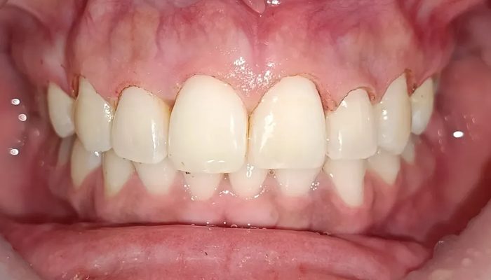 Después del tratamiento periodontal