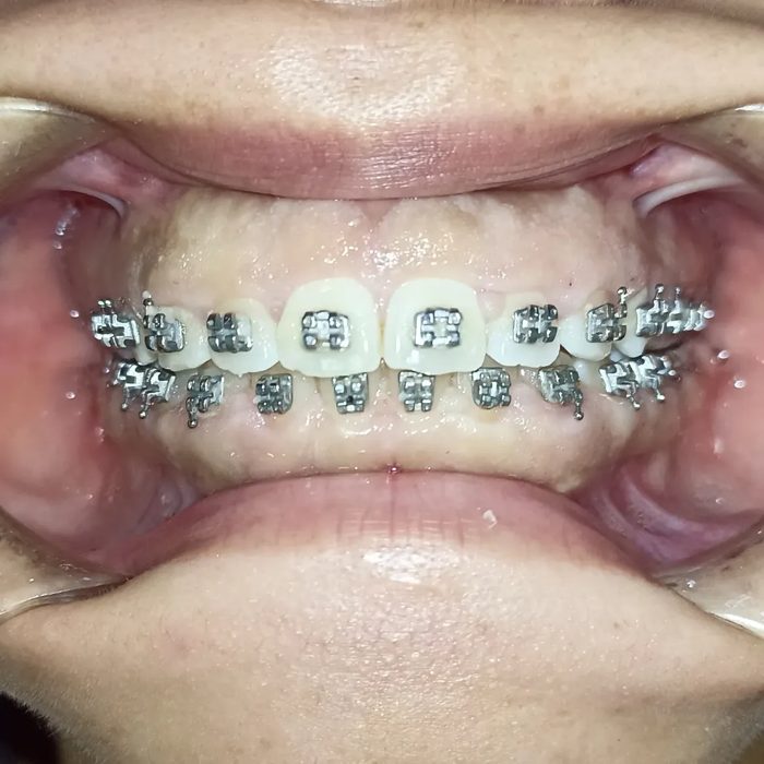 Antes de gingivectomía con electrobisturí