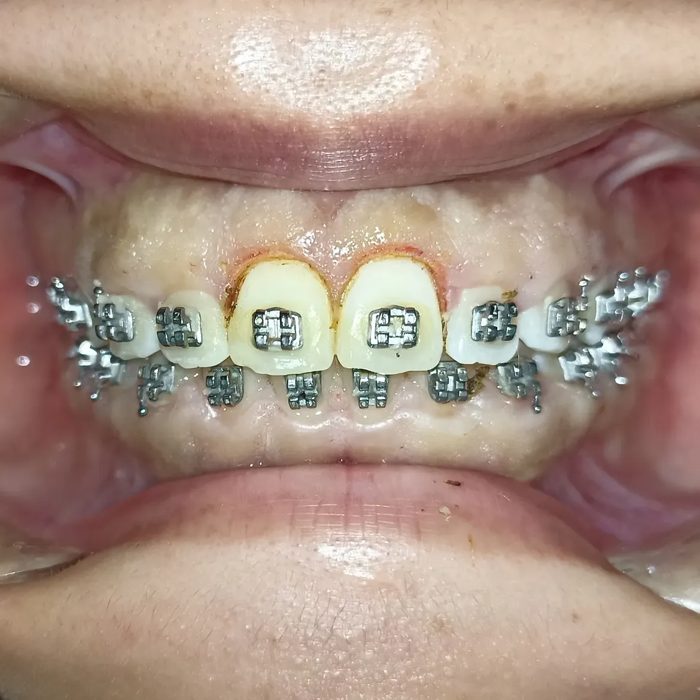 Resultado posquirúrgico de gingivectomía